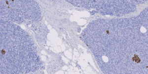 Detecting Type-2 Diabetes in histopathological images for a better understanding of biological 