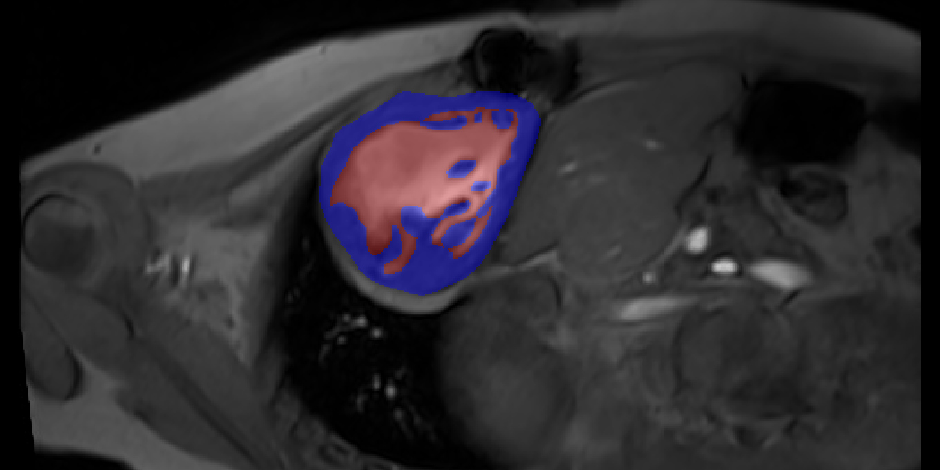 Extracting clinically relevant parameters from real-time MRI images of fontan hearts