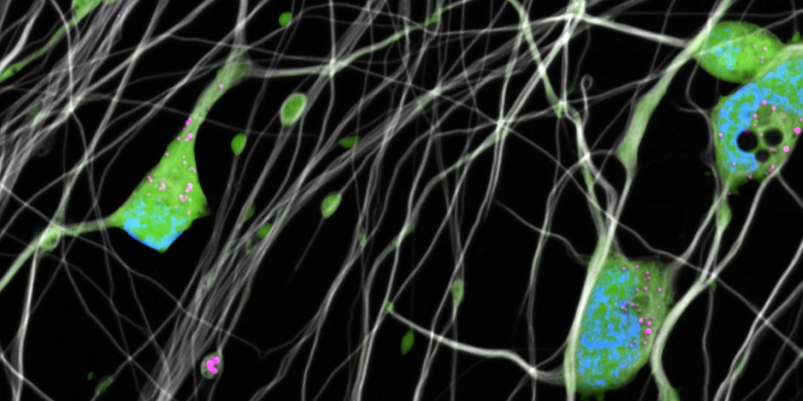 Image created by Elntem Sadikb Oglou; showing dying cortical neuron due to mild chronic oxidative stress induced Ferroptos