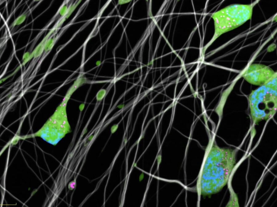 Image created by Elntem Sadikb Oglou; showing dying cortical neuron due to mild chronic oxidative stress induced Ferroptos