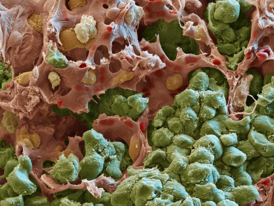 Visusal for SCHEMA;Metastases represent a significant exacerbation of tumor severity. If one could predict the likelihood of tumors metastasizing, this could inform treatment decisions to avoid or delay this outcome. SCHEMA develops a benchmark dataset of primary tumor samples and metadata on whether the tumor has metastasized at different time points after sampling. With this dataset, a challenge for machine learning scientists will be defined to build prognostic models for likelihood of tumors metastasizing, promoting innovation in prognostic modeling for a clinically relevant task.