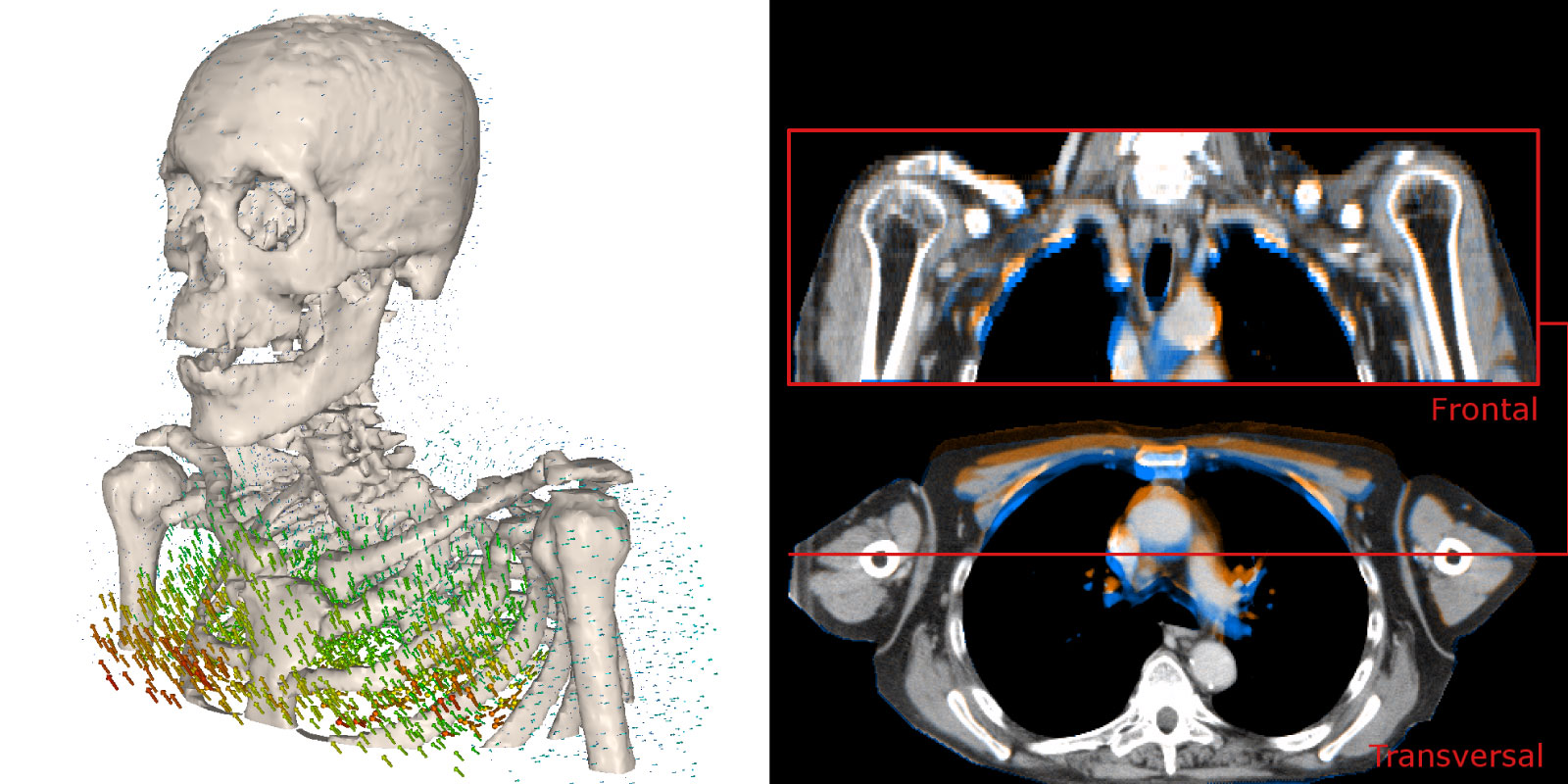 Composite medical visualization showing two related views of human anatomy. On the left, a 3D rendering of a human skeleton (skull, spine, ribs, and shoulders) with numerous colored vectors or arrows around the chest and rib cage indicating motion or force directions. On the right, two CT scan slices of the upper chest: a frontal view at the top and a transverse (cross-sectional) view at the bottom, with colored overlays highlighting anatomical structures around the lungs, heart, and shoulder area.