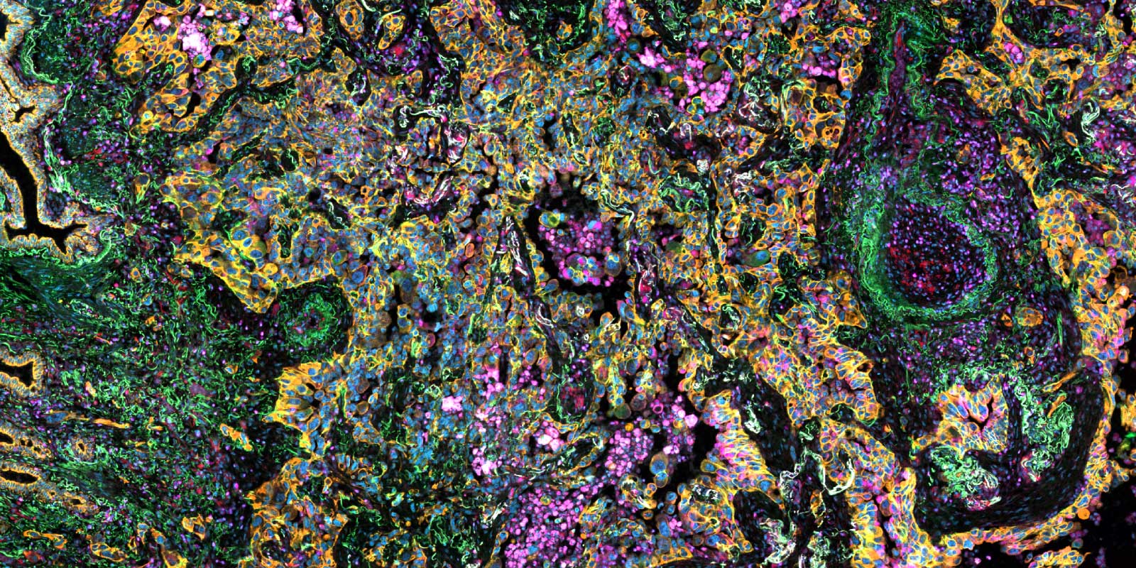 A highly detailed, abstract-looking microscopy image filled with tightly packed, irregular cell-like shapes. The scene is dominated by bright orange and blue outlines, with green streaks and patches weaving through the tissue, plus many small pink and purple clusters scattered throughout. The background is mostly black, which makes the fluorescent colors stand out strongly. Information about the image: To develop novel strategies targeting the tumor microenvironment in lung adenocarcinoma, the TME was stained for cell type specific markers and imaged on an Axioscan 7 Slidescanner.