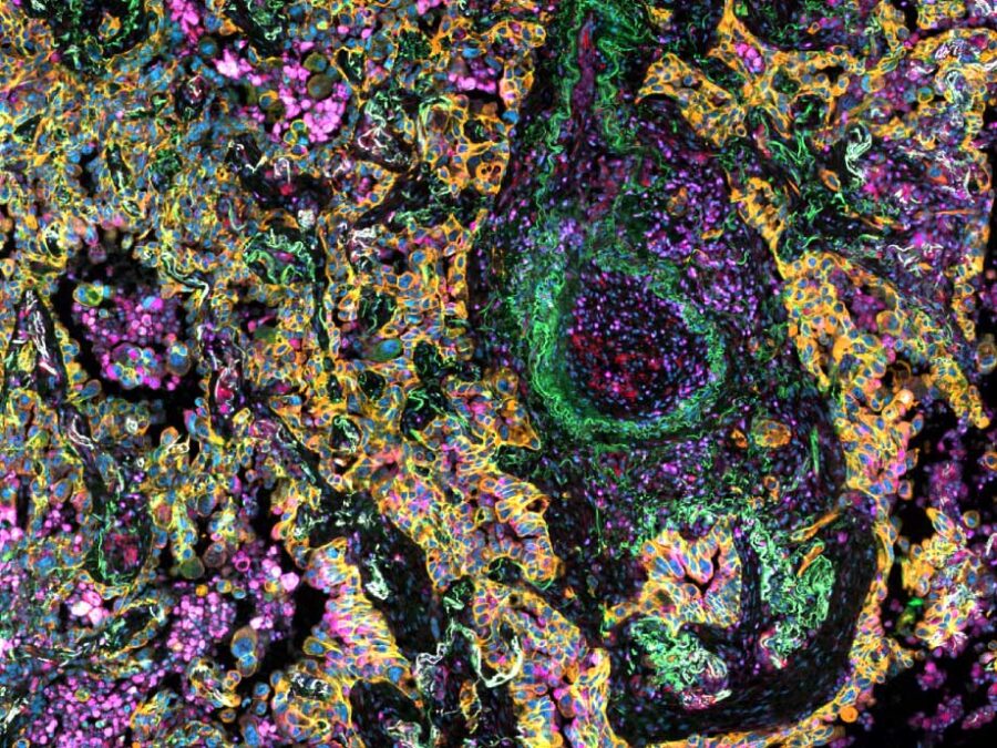 A highly detailed, abstract-looking microscopy image filled with tightly packed, irregular cell-like shapes. The scene is dominated by bright orange and blue outlines, with green streaks and patches weaving through the tissue, plus many small pink and purple clusters scattered throughout. The background is mostly black, which makes the fluorescent colors stand out strongly. Information about the image: To develop novel strategies targeting the tumor microenvironment in lung adenocarcinoma, the TME was stained for cell type specific markers and imaged on an Axioscan 7 Slidescanner.